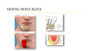 MENTAL NERVE BLOCK
 