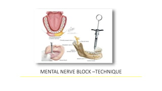 MENTAL NERVE BLOCK –TECHNIQUE
 