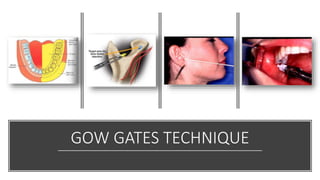 GOW GATES TECHNIQUE
 