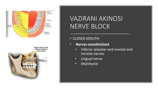 VAZIRANI AKINOSI
NERVE BLOCK
• CLOSED MOUTH
• Nerves anesthetized
• Inferior alveolar and mental and
incisive nerves
• Lingual nerve
• Mylohyoid
 