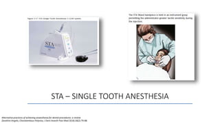 STA – SINGLE TOOTH ANESTHESIA
Alternative practices of achieving anaesthesia for dental procedures: a review
Zavattini Angelo, Charalambous Polyvios, J Dent Anesth Pain Med 2018;18(2):79-88
 