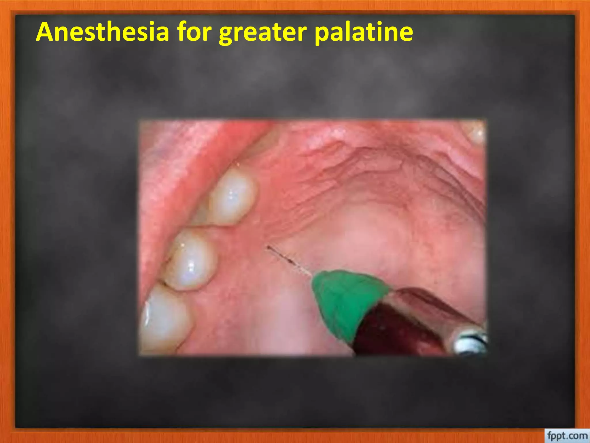 Local Anaesthesia Injection Local anesthesia | PPTX