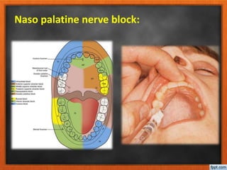Inferior alveolar nerve block (IAN)
Technique involves blocking the inferior alveolar
nerve prior to entry into the mandib...