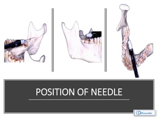 POSITION OF NEEDLE
 
