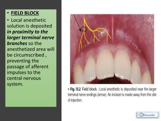 • FIELD BLOCK
• Local anesthetic
solution is deposited
in proximity to the
larger terminal nerve
branches so the
anesthetized area will
be circumscribed ,
preventing the
passage of afferent
impulses to the
central nervous
system.
 