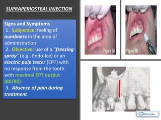 SUPRAPERIOSTEAL INJECTION
• Anaesthetize buccal soft tissue
& hard tissue
• Nerves anaesthetized – large
terminal branches
• Indication : 1 or 2 teeth need to
be anaesthetized small area
• Contra-indication :
Infection, Dense bone covering
• Target area :
• Behind apices of tooth
• Landmarks :
• Muco-buccal fold
• Crown & root length
Signs and Symptoms
1. Subjective: feeling of
numbness in the area of
administration
2. Objective: use of a “freezing
spray” (e.g., Endo-Ice) or an
electric pulp tester (EPT) with
no response from the tooth
with maximal EPT output
(80/80)
3. Absence of pain during
treatment 
 