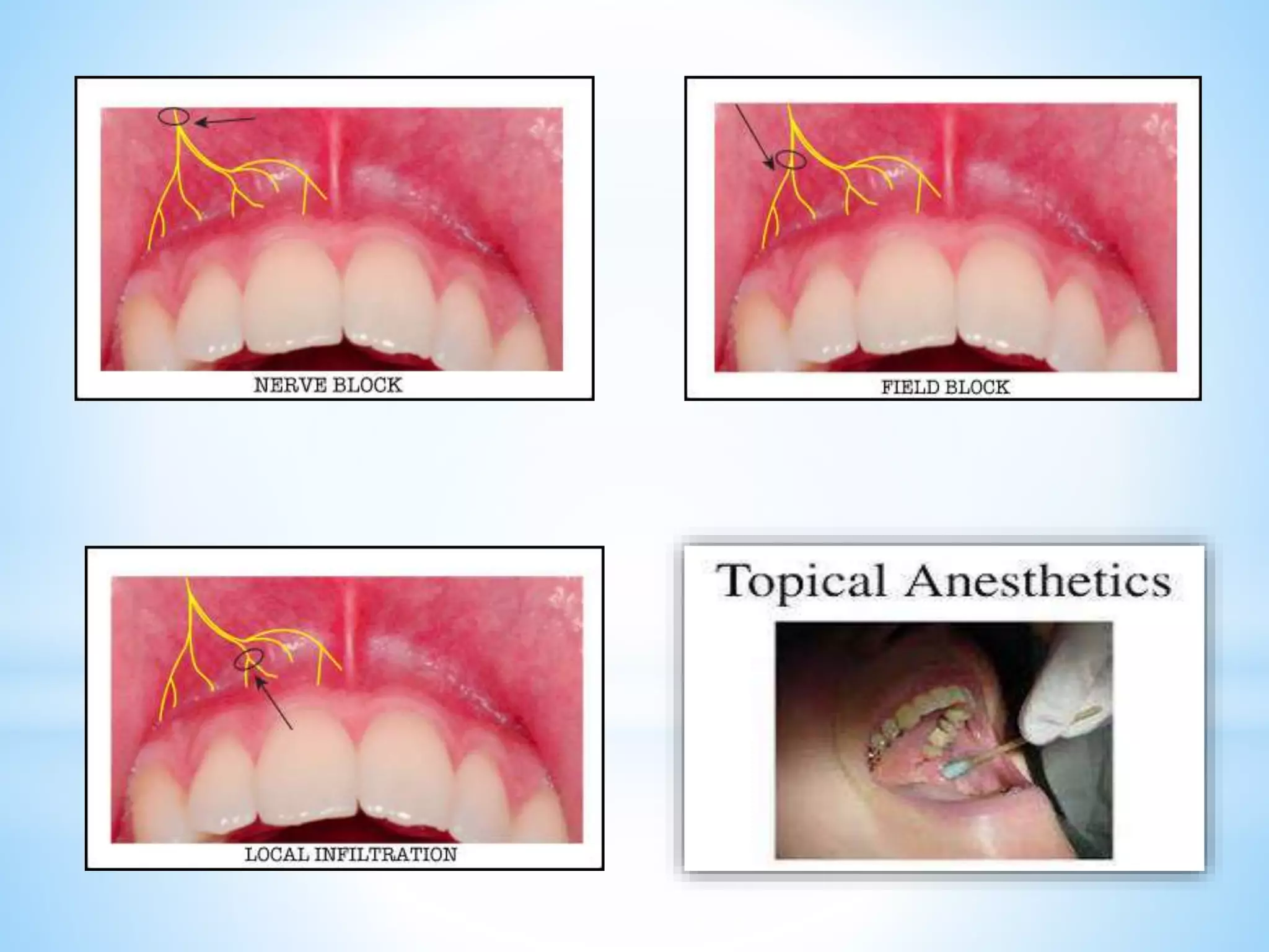 LOCAL ANESTHESIA.pptx
