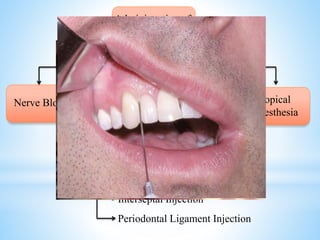 Nerve Block Field Block
Submucosal Injection
Paraperiosteal Injection
Intraosseous Injection
Interseptal Injection
Periodontal Ligament Injection
Local
Infiltration
Administration of
LA
Topical
Anesthesia
 
