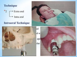 Technique
*2 Extra oral
Intra oral
Intraoral Technique
*Infraorbital ridge is palpated and 1cm inferior to it, the
infraorbital foramen is palpated with middle finger.
*The needle is inserted at the apex of the canine fossa or along
the long axis of the first premolar
 