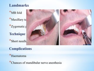 Landmarks
*MB fold
*Maxillary tuberosity
*Zygomatic process of maxilla
Technique
*Short needle
Complications
*Haematoma
*Chances of mandibular nerve anesthesia
 