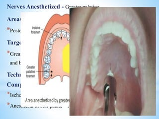 Nerves Anesthetized - Greater palatine
Areas Anesthetized
*Posterior portion of hard palate and its overlying tissues
Target Area
*Greater palatine nerve as it passes anteriorly between soft tissues
and bone of the hard palate
Technique
Complications
*Ischemia of palate
*Anesthesia of soft palate – leads to gagging
 