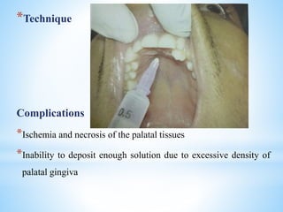 *Technique
Complications
*Ischemia and necrosis of the palatal tissues
*Inability to deposit enough solution due to excessive density of
palatal gingiva
 