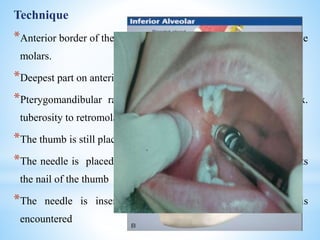 Technique
*Anterior border of the ramus is palpated as sharp edge lateral to the
molars.
*Deepest part on anterior border – Coronoid notch
*Pterygomandibular raphe - ‘S’ shape curve - runs from max.
tuberosity to retromolar fossa
*The thumb is still placed on the coronoid notch
*The needle is placed from the opposite side premolar – it bisects
the nail of the thumb
*The needle is inserted around 3/4th till bony resistance is
encountered
 