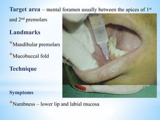 Target area – mental foramen usually between the apices of 1st
and 2nd premolars
Landmarks
*Mandibular premolars
*Mucobuccal fold
Technique
Symptoms
*Numbness – lower lip and labial mucosa
 