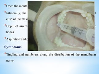 *Open the mouth wide
*Intraorally, the needle is penetrated just below the mesiopalatal
cusp of the maxillary 2nd molar along the imaginary line
*Depth of insertion of the needle will be at least 3/4th ( contact the
bone)
*Aspiration and deposition of 2cc solution
Symptoms
*Tingling and numbness along the distribution of the mandibular
nerve
 