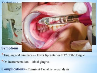 Technique
*Patient is asked to close the mouth till the teeth occlude
*Cheek retracted and needle is inserted parallel to the occlusal plane at
the level of mucogingival junction of max. arch
*Needle is inserted medial to the ramus. About 3/4th of the needle is
inserted
*Aspiration and deposition of 2cc solution
Symptoms
*Tingling and numbness – lower lip, anterior 2/3rd of the tongue
*On instrumentation – labial gingiva
Complications – Transient Facial nerve paralysis
 
