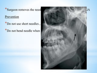 *Surgeon removes the needle fragment while patient is under GA
Prevention
*Do not use short needles , 25 gauge needles for IANB
*Do not bend needle when inserting them into soft tissues
 