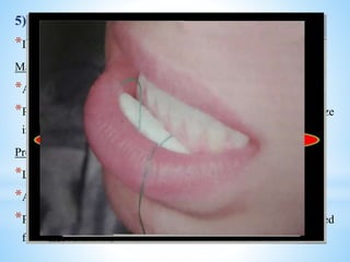 5) Soft Tissue Injury
*Inadvertent biting or chewing of lips or tongue
Management
*Analgesics and Antibiotics
*Petroleum jelly or other lubricant to cover lip lesions to minimize
irritation
Prevention
*LA of appropriate duration should be selected
*A cotton roll is placed between lips and teeth
*Parents should be informed to take care that the child is prevented
from lip biting or chewing
 