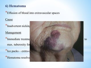 6) Hematoma
*Effusion of blood into extravascular spaces
Cause
*Inadvertent nicking of a blood vessel during LA administration
Management
*Immediate treatment – pressure application in the region post. to
max. tuberosity for PSA block
*Ice packs – extra-orally
*Hematoma resolves by itself within 7 – 14 days
 