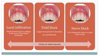 TYPES OF BLOCK
Local infiltration
Small terminal nerve endings
in the area of the dental
treatment.
Field block
Larger terminal nerve branches
are anesthetized.
Nerve block
LA is deposited close to a main
nerve trunk.
TYPES OF NERVE BLOCK
 