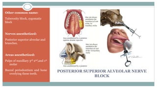 POSTERIOR SUPERIOR ALVEOLAR NERVE
BLOCK
Other common name:
Tuberosity block, zygomatic
block
Nerves anesthetized:
Posterior superior alveolar and
branches.
Areas anesthetized:
Pulps of maxillary 3rd 2nd,and 1st
molar
Buccal periodontium and bone
overlying these teeth.
 
