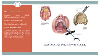 NASOPALATINE NERVE BLOCK
Other common names:
Incisive nerve block,
Sphenopalatine nerve block.
Nerves anesthetized:
Nasopalatine nerves bilaterally.
Areas anesthetized:
Anterior portion of the hard
palate bilaterally from the mesial
of left first premolar to the mesial
of the right first premolar.
 