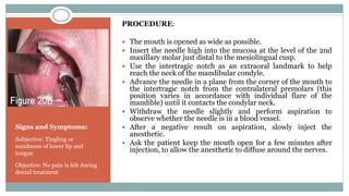 Signs and Symptoms:
Subjective: Tingling or
numbness of lower lip and
tongue
Objective: No pain is felt during
dental treatment
PROCEDURE:
 The mouth is opened as wide as possible.
 Insert the needle high into the mucosa at the level of the 2nd
maxillary molar just distal to the mesiolingual cusp.
 Use the intertragic notch as an extraoral landmark to help
reach the neck of the mandibular condyle.
 Advance the needle in a plane from the corner of the mouth to
the intertragic notch from the contralateral premolars (this
position varies in accordance with individual flare of the
mandible) until it contacts the condylar neck.
 Withdraw the needle slightly and perform aspiration to
observe whether the needle is in a blood vessel.
 After a negative result on aspiration, slowly inject the
anesthetic.
 Ask the patient keep the mouth open for a few minutes after
injection, to allow the anesthetic to diffuse around the nerves.
 