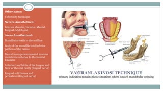 VAZIRANI-AKINOSI TECHNIQUE
primary indication remains those situations where limited mandibular opening
Other name:
Tuberosity technique
Nerves Anesthetized:
Inferior alveolar, Incisive, Mental,
Lingual, Mylohyoid
Areas Anesthetized:
Mandibularteeth to the midline
Body of the mandible and inferior
portion of the ramus
Buccal mucoperiosteumand mucous
membrane anterior to the mental
foramen
Anterior two thirds of the tongue and
floor of the oral cavity (lingual nerve)
Lingual soft tissues and
periosteum(lingual nerve)
 