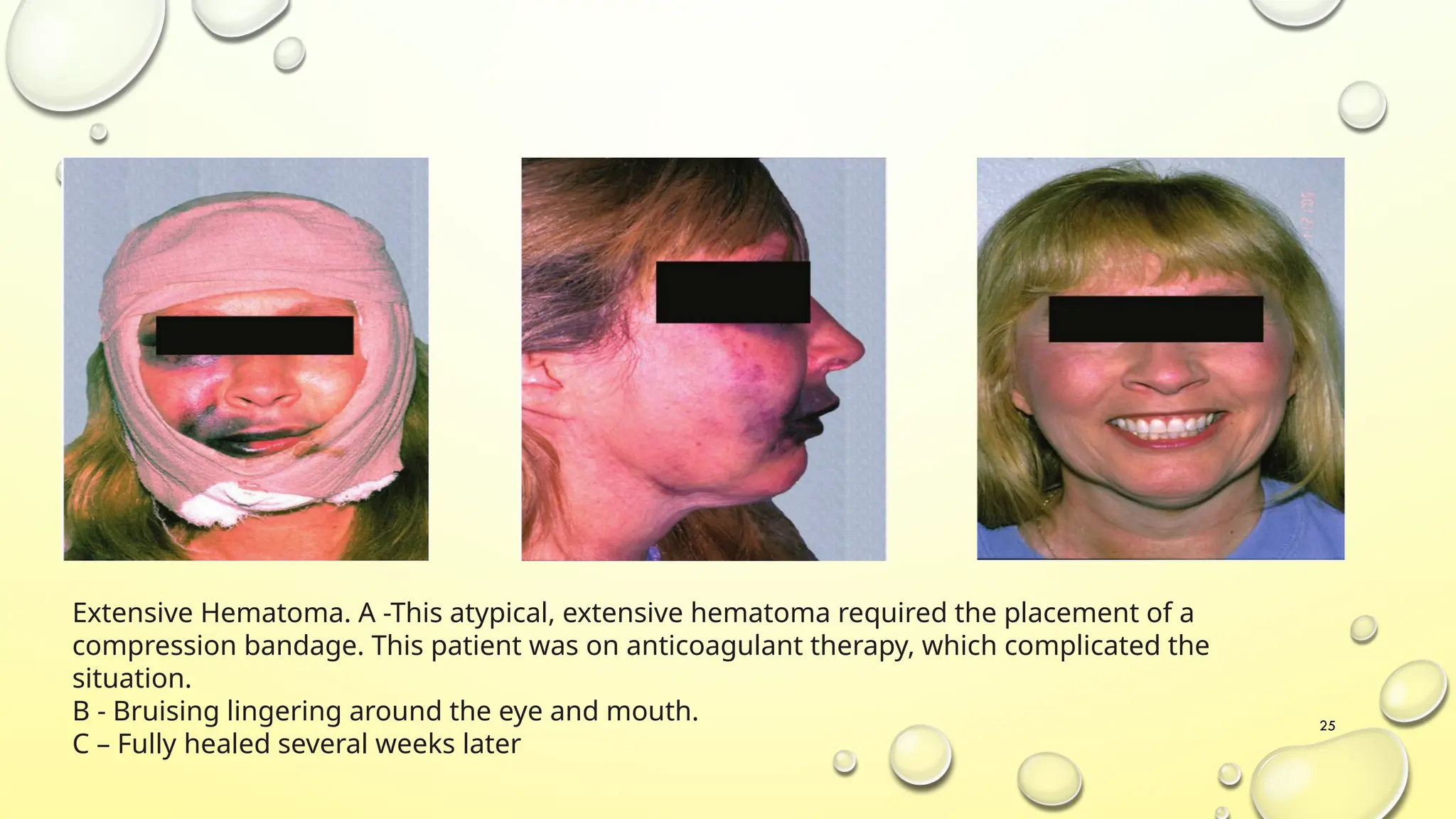 Series of facial hematoma images showing progression of swelling and bruising