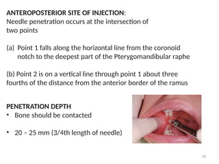 Intersection Injection Comprehensive Overview of Local Anesthesia in Dental Practice | PPTX