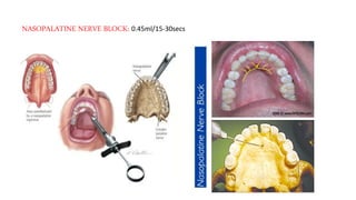 Np Injection Local anesthesia in dentistry | PPTX