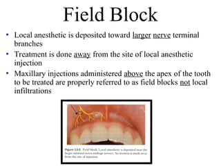Local Anesthesia Field Block Local anesthesia in oral surgery and technique | PPT