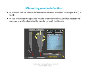 Minimizing needle deflection
• In order to reduce needle deflection Birotational Insertion Technique (BRIT) is
used.
• In this technique the operator rotates the needle in back and forth rotational
movement while advancing the needle through the tissues
handbook of local anesthesia by stanley F.
malamed 6th edition
 