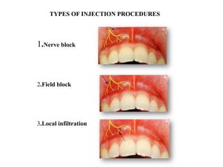 1.Nerve block
2.Field block
3.Local infiltration
TYPES OF INJECTION PROCEDURES
 