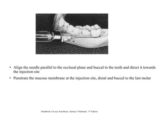 • Align the needle parallel to the occlusal plane and buccal to the teeth and direct it towards
the injection site
• Penetrate the mucous membrane at the injection site, distal and buccal to the last molar
Handbook of Local Anesthesia. Stanley F Malamed. 5th Edition.
 