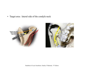 • Target area : lateral side of the condyle neck
Handbook of Local Anesthesia. Stanley F Malamed. 5th Edition.
 
