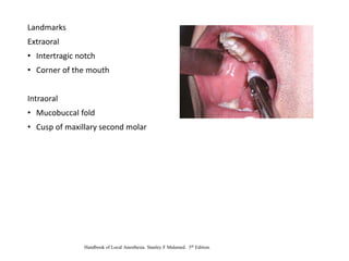 Landmarks
Extraoral
• Intertragic notch
• Corner of the mouth
Intraoral
• Mucobuccal fold
• Cusp of maxillary second molar
Handbook of Local Anesthesia. Stanley F Malamed. 5th Edition.
 