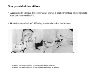 • According to yamada 1981 gow gates shows higher percentage of success rate
then conventional IANB.
• But it has drawback of difficulty in administration in children.
Gow gates block in children
Mcdonald and avery’s dentistry for the child and adolescent 8th edi
Mcdonald nad avery’s dentistry for the child and adolescent ,8th edition
 