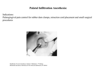 Palatal Infiltration Anesthesia:
Indications:
Palatogingival pain control for rubber dam clamps, retraction cord placement and small surgical
procedures
Handbook of Local Anesthesia. Stanley F Malamed. 5th Edition.
Mcdonald nad avery’s dentistry for the child and adolescent ,8th edition
 