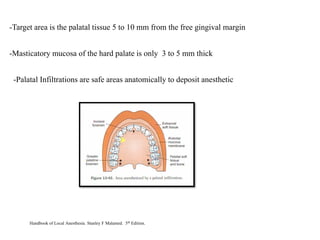 -Target area is the palatal tissue 5 to 10 mm from the free gingival margin
-Masticatory mucosa of the hard palate is only 3 to 5 mm thick
-Palatal Infiltrations are safe areas anatomically to deposit anesthetic
Handbook of Local Anesthesia. Stanley F Malamed. 5th Edition.
 
