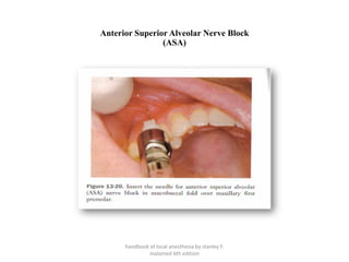 handbook of local anesthesia by stanley F.
malamed 6th edition
Anterior Superior Alveolar Nerve Block
(ASA)
 
