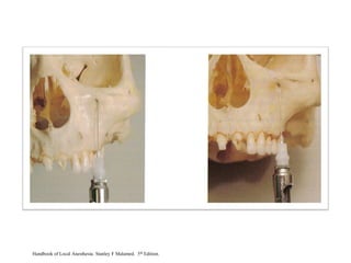Handbook of Local Anesthesia. Stanley F Malamed. 5th Edition.
 