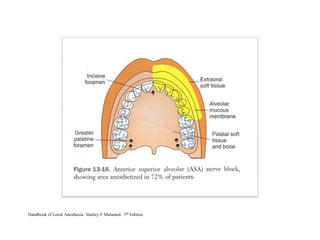 Handbook of Local Anesthesia. Stanley F Malamed. 5th Edition.
 