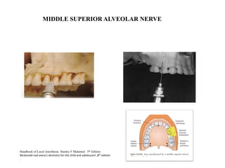 Handbook of Local Anesthesia. Stanley F Malamed. 5th Edition
Mcdonald nad avery’s dentistry for the child and adolescent ,8th edition
.
MIDDLE SUPERIOR ALVEOLAR NERVE
 