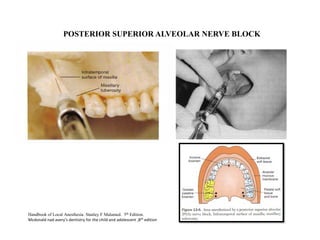 Handbook of Local Anesthesia. Stanley F Malamed. 5th Edition.
Mcdonald nad avery’s dentistry for the child and adolescent ,8th edition
POSTERIOR SUPERIOR ALVEOLAR NERVE BLOCK
 