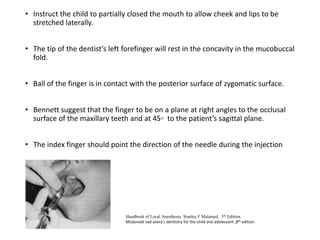 • Instruct the child to partially closed the mouth to allow cheek and lips to be
stretched laterally.
• The tip of the dentist’s left forefinger will rest in the concavity in the mucobuccal
fold.
• Ball of the finger is in contact with the posterior surface of zygomatic surface.
• Bennett suggest that the finger to be on a plane at right angles to the occlusal
surface of the maxillary teeth and at 45◦ to the patient’s sagittal plane.
• The index finger should point the direction of the needle during the injection
Handbook of Local Anesthesia. Stanley F Malamed. 5th Edition.
Mcdonald nad avery’s dentistry for the child and adolescent ,8th edition
 