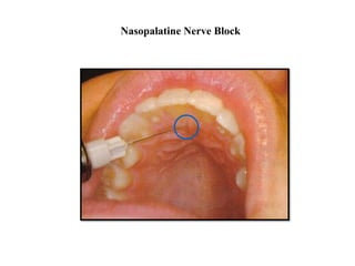 Nasopalatine Nerve Block
 