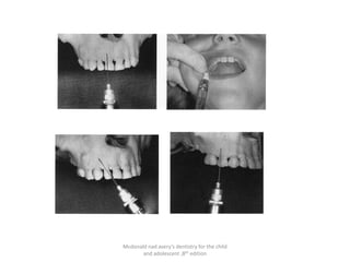 Mcdonald nad avery’s dentistry for the child
and adolescent ,8th edition
 