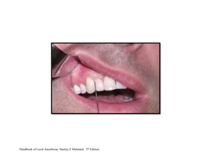 Handbook of Local Anesthesia. Stanley F Malamed. 5th Edition.
 