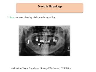 Rare because of using of disposable needles.
Needle Breakage
Handbook of Local Anesthesia. Stanley F Malamed. 5th Edition.
 